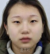 八大处于晓波双眼皮修复案例|果真的很好! width=