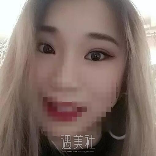八大处于晓波双眼皮修复案例|果真的很好!