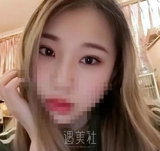 八大处于晓波双眼皮修复案例|果真的很好!