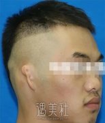 八大处章庆国耳再造案例，我也能像正常人一样了! width=