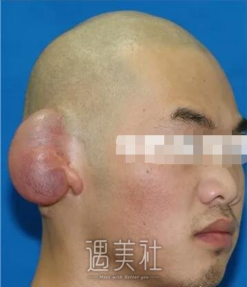 八大处章庆国耳再造案例，我也能像正常人一样了!
