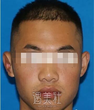 八大处章庆国耳再造案例，我也能像正常人一样了!