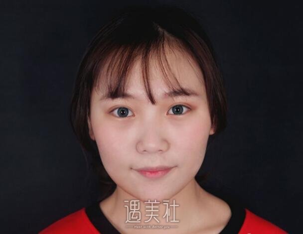 北京八大处鼻部手术案例展示|这还是我吗?