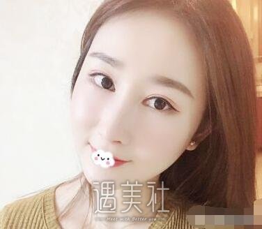 贝拉陈松涛鼻部手术案例|气质完全不一样了!