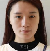 华西卿勇鼻部手术案例|与平板脸说拜拜! width=
