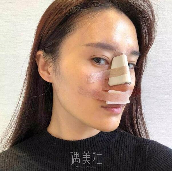 华西卿勇鼻部手术案例|与平板脸说拜拜!