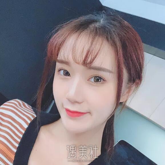 华西卿勇鼻部手术案例|与平板脸说拜拜!