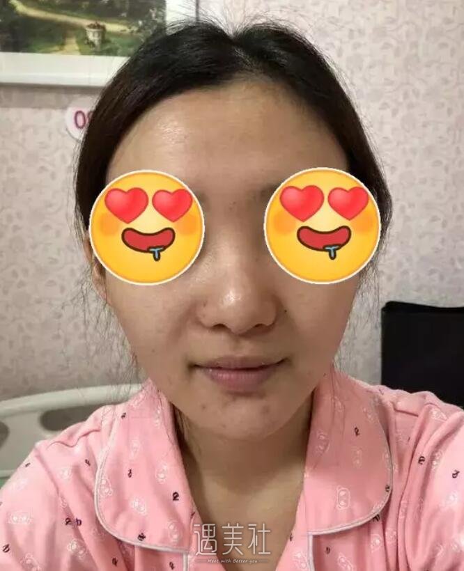 李鸿君修复鼻子案例|果很!