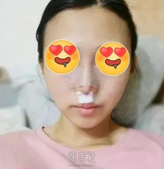 李鸿君修复鼻子案例|果很!