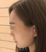 李青峰隆鼻案例展示|小姐姐的惊人蜕变! width=