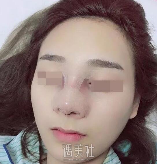 李青峰隆鼻案例展示|小姐姐的惊人蜕变!