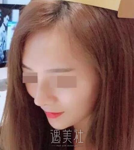 李青峰隆鼻案例展示|小姐姐的惊人蜕变!