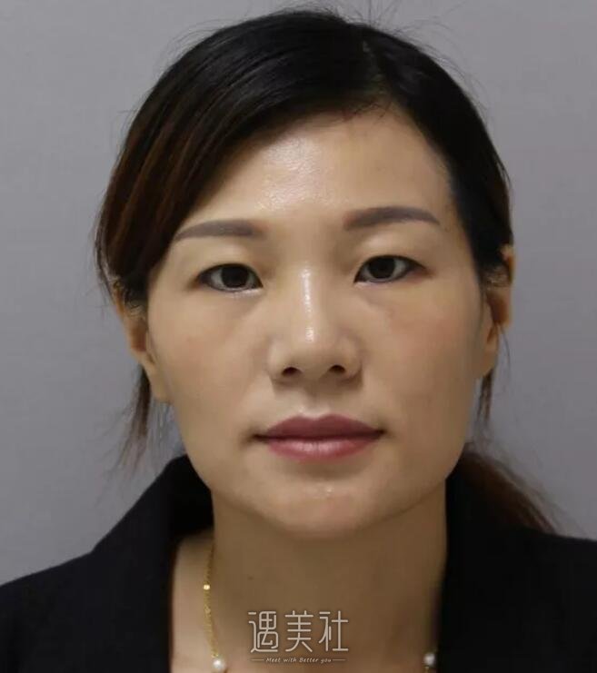 李战强鼻修复案例展示|看了我也想做!