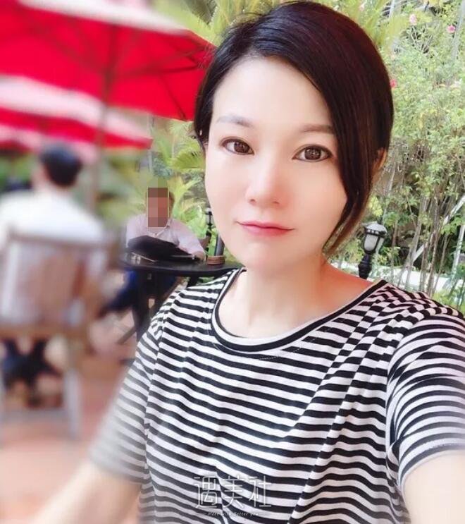 李战强鼻修复案例展示|看了我也想做!