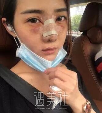米兰陈倩鼻部手术果如何?案例及果图展示!