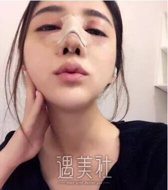 米兰陈倩鼻部手术果如何?案例及果图展示!