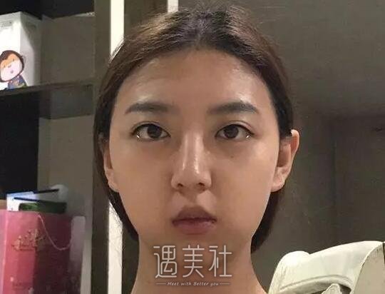 南宁东方整形垫下巴案例|整个脸型都变了!