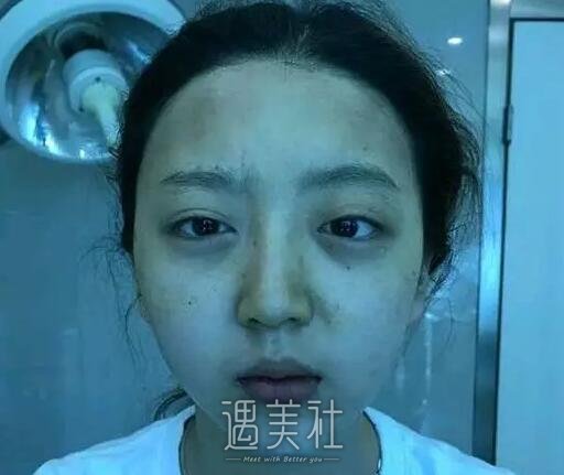 南宁东方整形垫下巴案例|整个脸型都变了!
