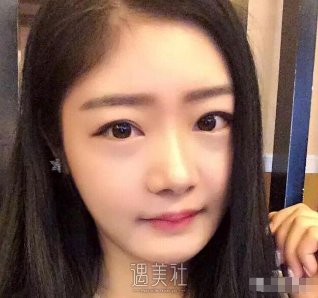上海华美垫下巴案例|摸着真带劲!