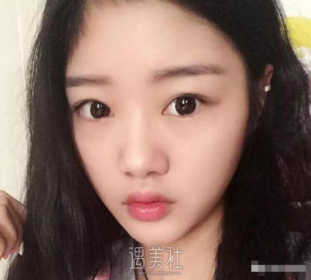 上海华美垫下巴案例|摸着真带劲!