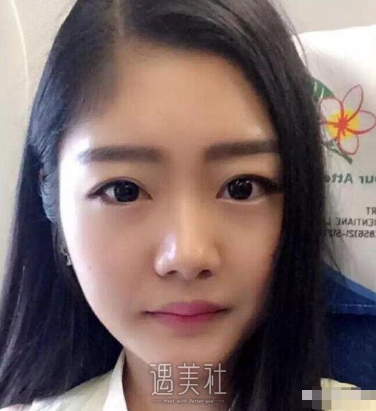 上海华美垫下巴案例|摸着真带劲!