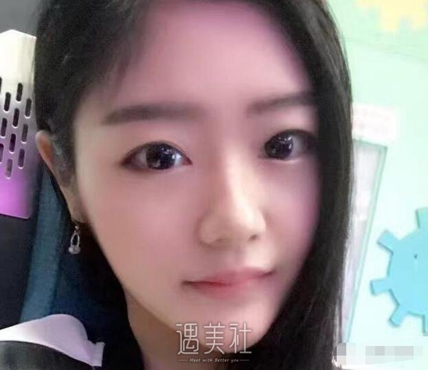 上海华美垫下巴案例|摸着真带劲!