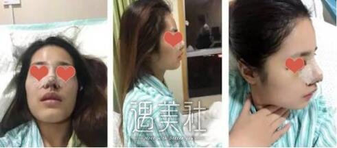 王海平做隆鼻案例|简直漂亮了不少!