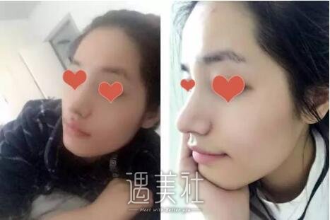 王海平做隆鼻案例|简直漂亮了不少!
