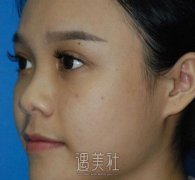 赵绛波鼻部手术案例|前后差距果然大! width=
