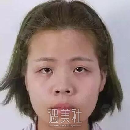 周长兵隆鼻案例分享|技术确实较为好!