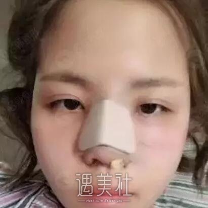 周长兵隆鼻案例分享|技术确实较为好!
