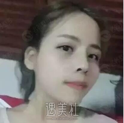 周长兵隆鼻案例分享|技术确实较为好!