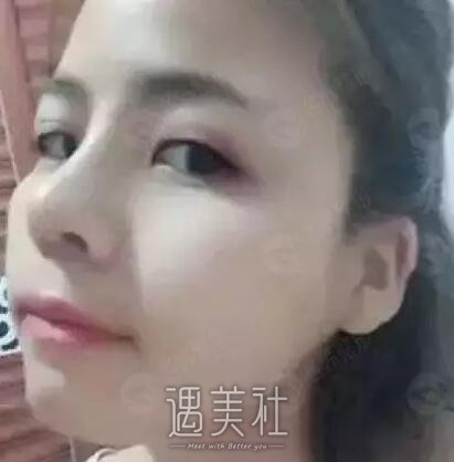 周长兵隆鼻案例分享|技术确实较为好!