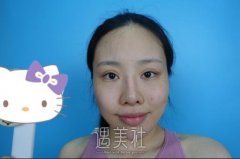 华美谢卫国海鸥线定制隆鼻案例：喜提挺拔高鼻梁~ width=