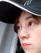 九院周一雄双眼皮修复案例：从糟糕变成自然的眼睛 width=