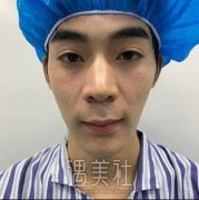 上海华美李建鼻部手术案例：男生隆鼻82天前后对比变化 width=