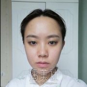周慧芳埋线双眼皮案例：60天术前术后对比分享~ width=