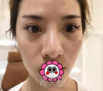 江华医生隆鼻案例：恢复的可真快呀 width=