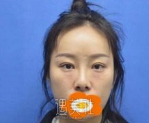 华美杨健隆鼻案例：鼻头还有些许的弧度 width=