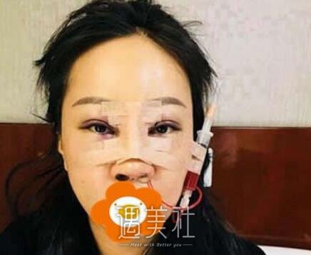 华美,杨健,隆鼻