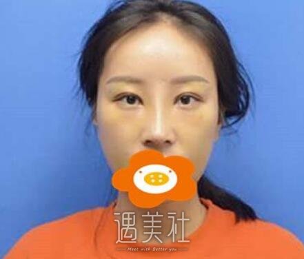 华美,杨健,隆鼻