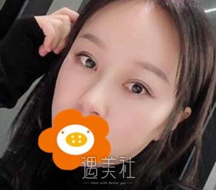 华美,杨健,隆鼻
