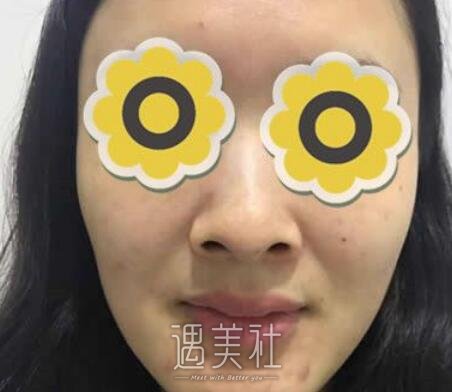 黄金龙，隆鼻