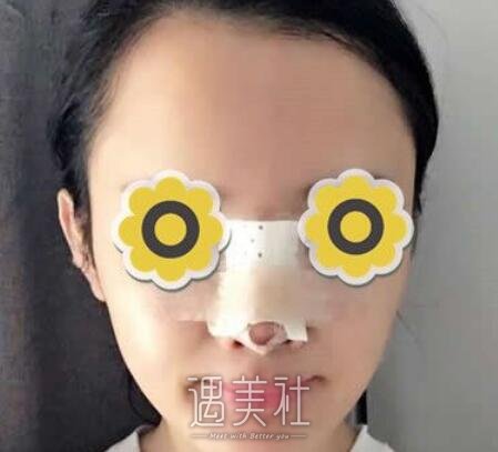 黄金龙，隆鼻