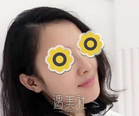 黄金龙，隆鼻