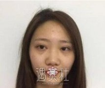 黄大勇隆鼻案例:半年了恢复的特别好 width=