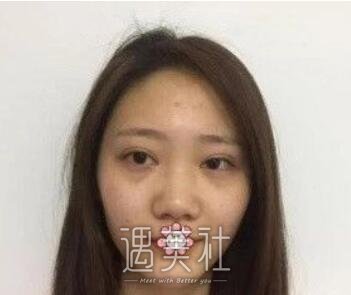 黄大勇,隆鼻