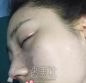黄大勇,隆鼻