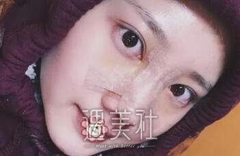 黄大勇,隆鼻