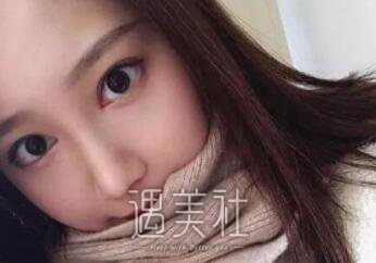 黄大勇,隆鼻